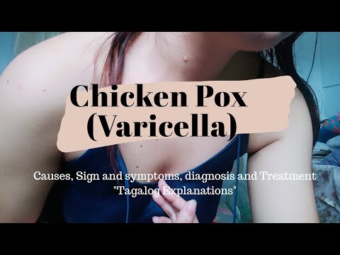 Chicken Pox/Bulutong Tubig | Causes, Sign & Symptoms, Diagnosis & Treatment| Tagalog | Part 1