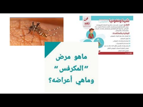 المكرفس او الشيكونغونيا والكورونا اهم التحديثات العلاجية لحل مشكلة إلتهاب المفاصل هام جدا اشترك