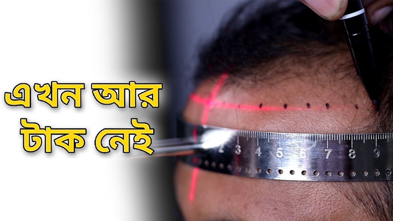 Hair Transplant Experience Hair Transplant Bangladesh YouTube