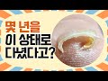 [내성발톱] 슬리퍼 신는 게 소원이요..? 맴찢...☆ 몇 년 묵은 내성발톱 2탄! eng