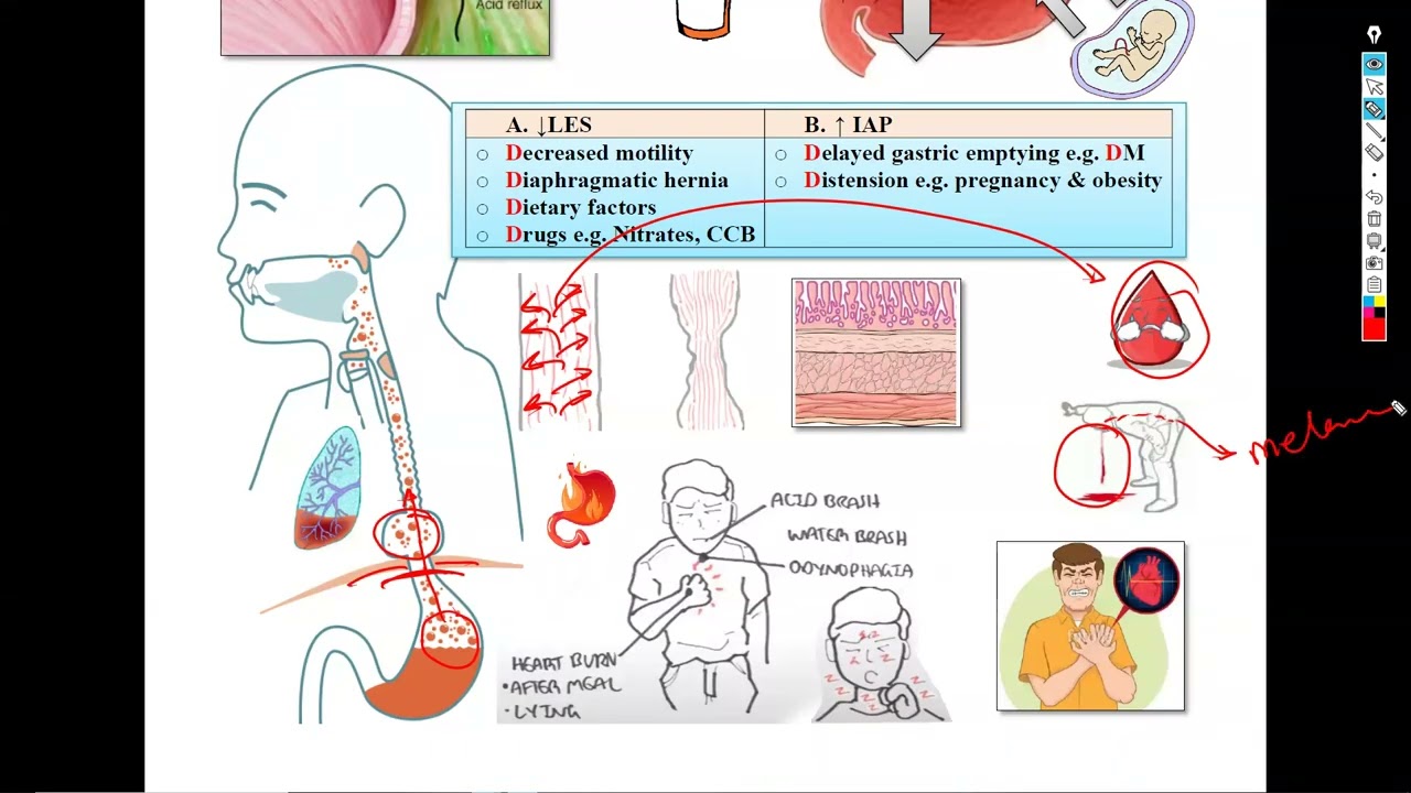 2-GERD, PU, FMF, Carcinoid syndrome شرح باطنة دكتور سويلم