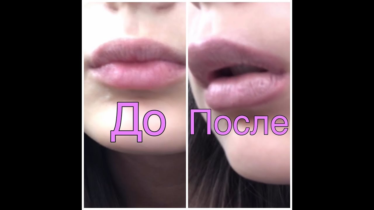 со скольки лет накачивают губы