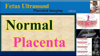 Fetus Ultrasound , Normal Placenta