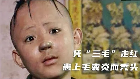 “三毛”長大了！8歲成名，14歲禿頂，34歲變帥哥，植髮挨300多針 - 天天要聞