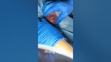 XỬ LÝ MỤN ÁP SE ,MỤN NHỌT | HOÀNG DƯƠNG