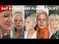 Day by day deep plane facelift recovery