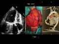 Günün hastası/ ALCAPA, mitral yetersizliğinin gözden kaçan sebebi olabilir