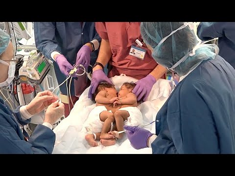 Separating Conjoined Twins