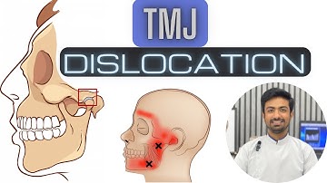 TMJ Dislocation and Management
