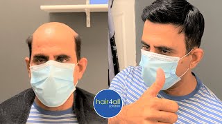 Before & After | Hair System | Non-Surgical Hair Replacement System Men/Women | UK/USA/International