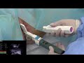 Transperineal Prostate Biopsy with Leapmed’s NEW Ultrasound Needle Guide for BK 8848