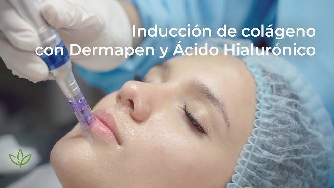 Ampolla con vitamina C para su aplicación directamente en la cara para el  procedimiento de mesoterapia con la ayuda de dermapen, aplicación de  líquido a la f Fotografía de stock - Alamy