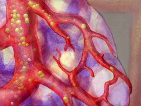 TACE and Anti-Angiogenic Drug Treatments for Liver Cancer ...