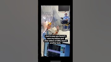 Another look at my DBS surgery videos….before and after the leads are placed.