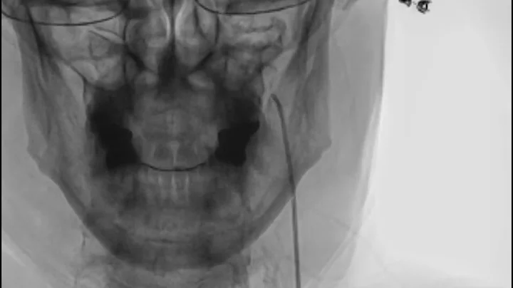 CCI Causing Internal Jugular Vein Compression