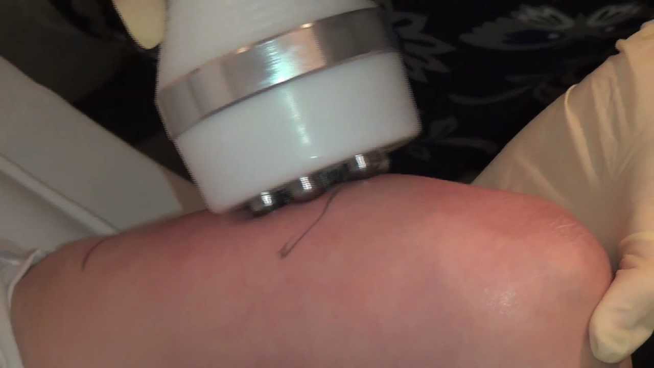 Shape & Shine - plaatselijk afvallen liften huidverbetering cavitatie