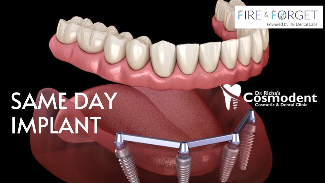 Screw Retained Implant Teeth to the Patient on Same Day | Most Affordable dentist in Mumbai.