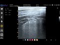 肺エコー　広範囲コンソリデーション-2