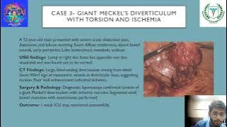 Mahim Singhal | CT Spectrum of Meckels diverticulum: case series