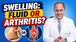 Leg Swelling: Is It Arthritis or Fluid Retention? 3 Key Signs You Should Know