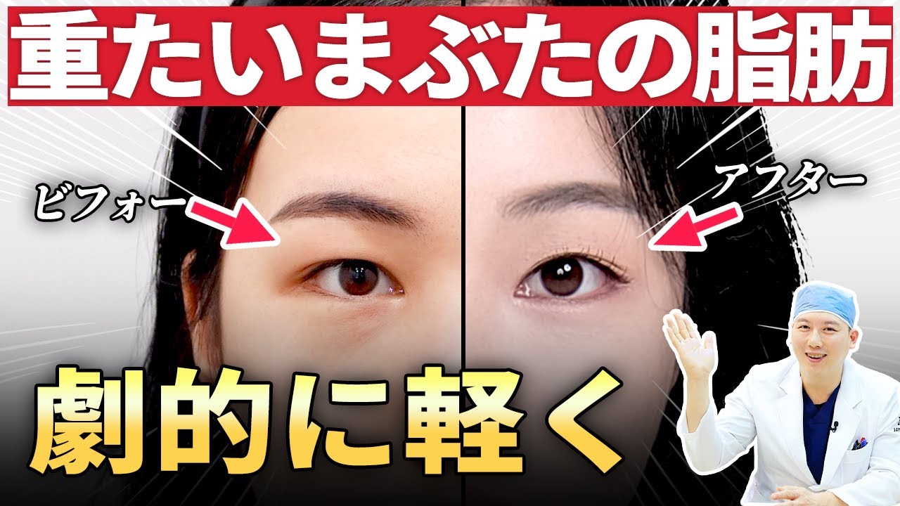 ​#厚い上瞼 #目の脂肪 #二重整形 #目整形 #二重切開法 #JAYJUN美容整形 #美容整形