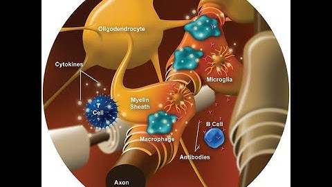 DMTs or Disease Modifying Therapies for Multiple Sclerosis. A patient experience of four of them.