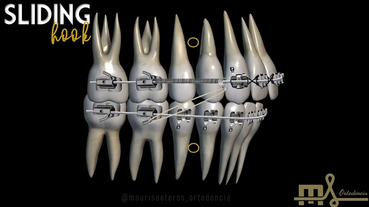 Sliding Hook Biomecánica