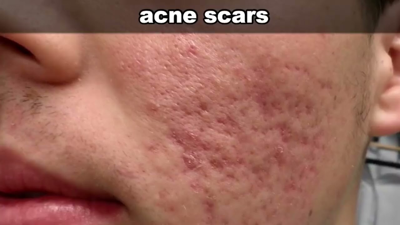 Ear Blackheads