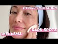 Dark Spot Treatments: Products I Love for Melasma & Hyperpigmentation | Skincare with @Susan Yara