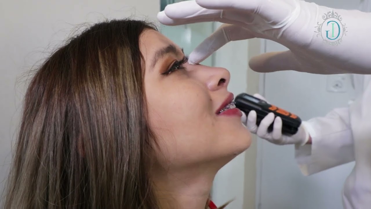 Rinoplastia Ultrasónica y Láser con el Dr. Iván Guanilo | Especialista en Rinoplastia