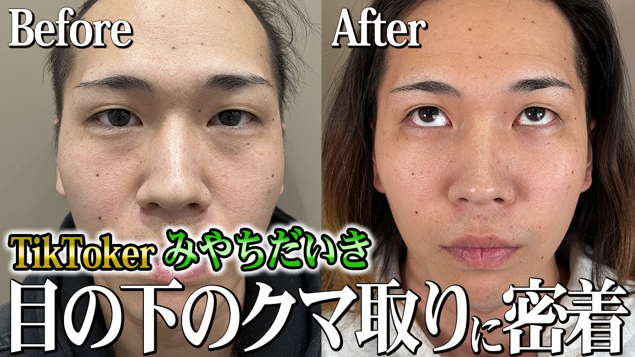 目の下のクマ取り】めちゃくちゃキレイな涙袋ができました！【みやちだ
