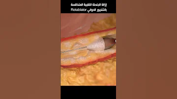 إزالة الجلطة القلبية المتكلسة بالشنيور الدوائي Rotablator 