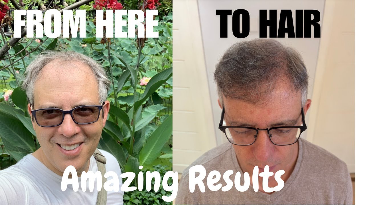 Hair Transplant Bangkok One Year Later at Hairtran Clinic Ekkamai! Will I do a Second Procedure?