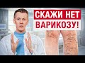 Избавляемся от варикоза РАЗ И НАВСЕГДА! / Как вернуть ногам красоту и здоровье?