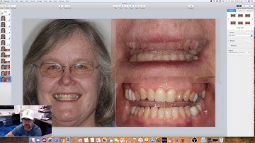 Keynote - Smile Design Part 2 - Loading all the photos