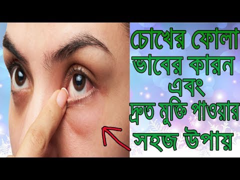 চোখের ফোলা ভাব থেকে দ্রুত মুক্তি পান...। Get Rid Of Eyes Puffy Ness