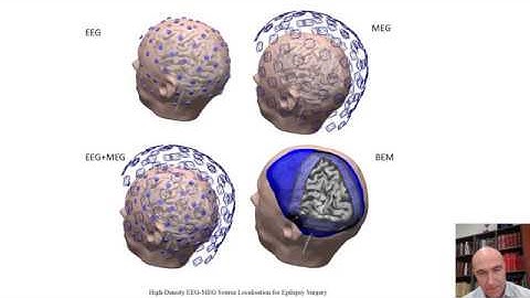 Interictal and ictal source localization for epilepsy surgery using high-density EEG with MEG: