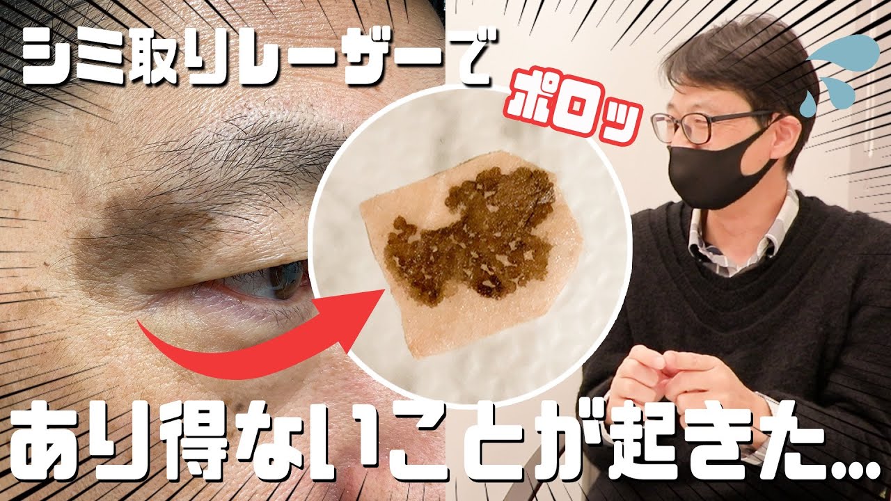 若返り あっという間に若返る 男性のシミ取り治療 シミ取り治療 Youtube