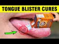 Tongue Blisters: 7 Simple And Effective Home Remedies To Soothe Swelling, Spots or Sores on Tongue