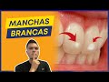 O QUE SÃO AS MANCHAS BRANCAS NOS DENTES? | 3 TIPOS MAIS COMUNS E TRATAMENTO.