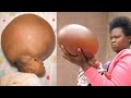 The Last Hope For Our Swollen Head Baby : THIS VIDEO WILL MAKE YOU CRY