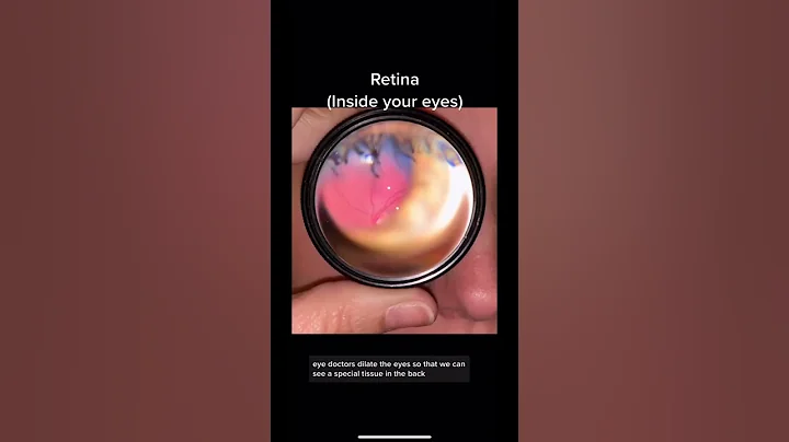 This is what eye doctors see when they look in the back of your eyes. They may dilate or take a pic.