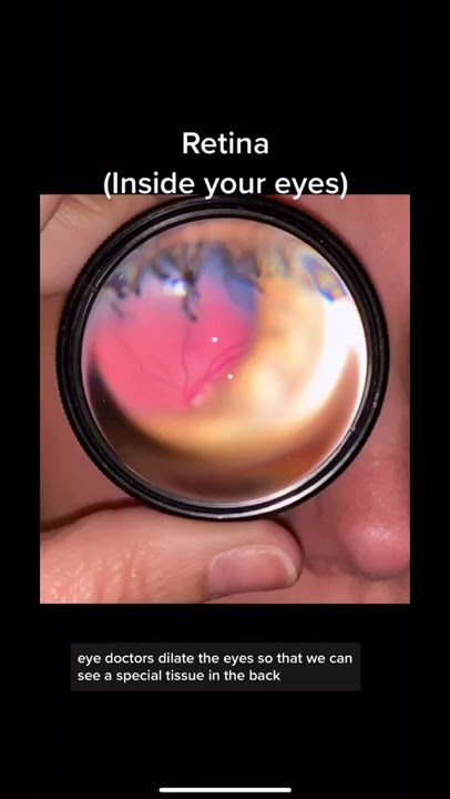 This is what eye doctors see when they look in the back of your eyes. They may dilate or take a pic.