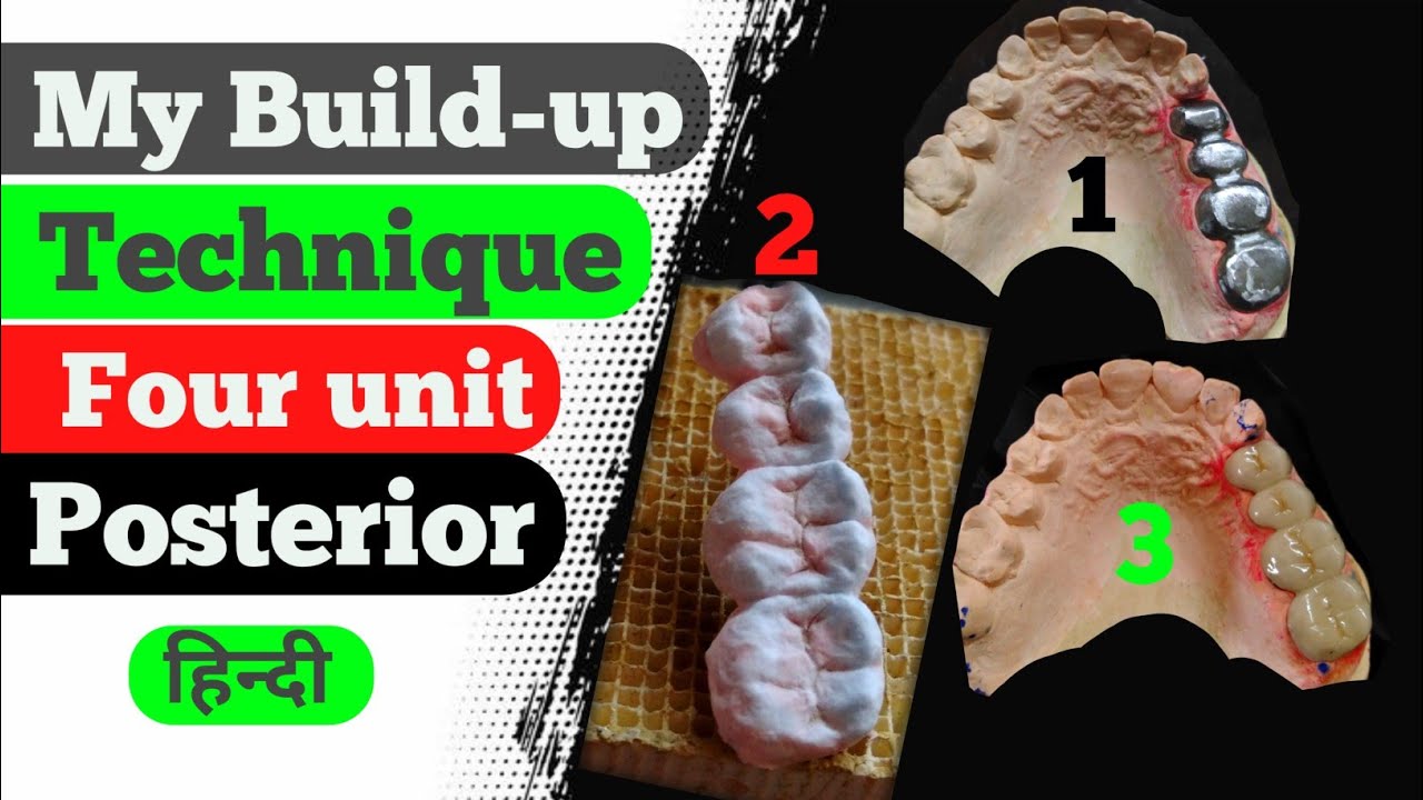 Upper 4Unit Layering Metal Ceramic How to layering ceramic Dental