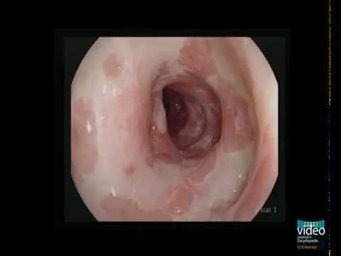 Endoscopic Findings in Ulcerative Colitis