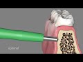 Установка импланта ортодонтического tomas SD