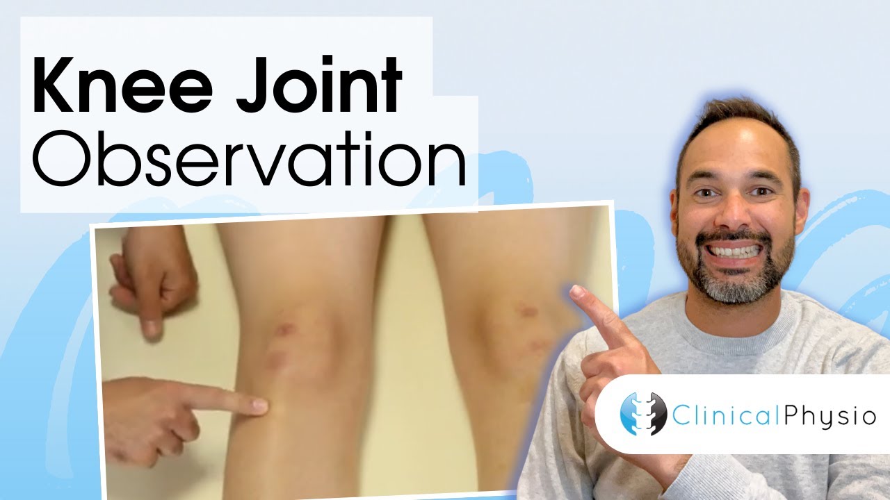 Observation of the Knee Joint | Clinical Physio