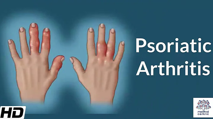 Psoriatic Arthritis, Causes, Signs and Symptoms, Diagnosis and Treatment.
