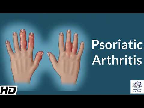 Video: Diagnostisering Och Behandling Av Psoriasisartrit