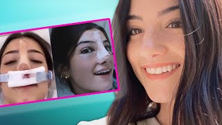 Charli D Amelio Does Tik Toks After Nose Surgery Hollywire